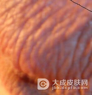 治疗阴囊湿疹注意的问题有哪些呢?
