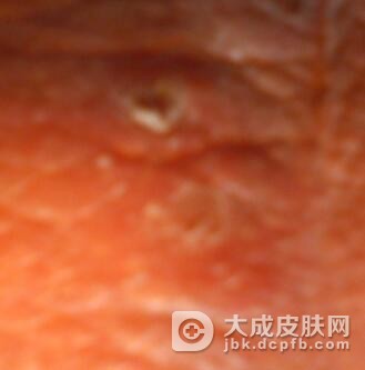 男性阴囊湿疹该怎么办呢?