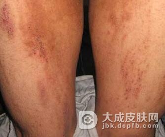 皮肤瘙痒对老人的危害有什么