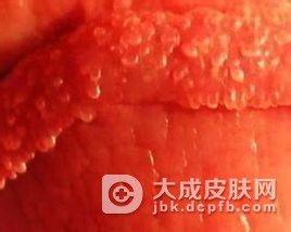 儿童尖锐湿疣的传染途径都有哪些
