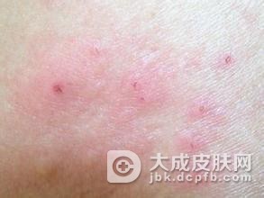 化妆品接触性皮炎如何治