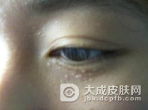汗管瘤有哪些表现
