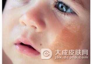 青胎记该如何通过饮食来护理