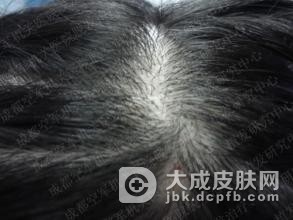 病理性脱发都是因为缺碘引起的吗