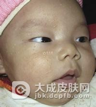 长汗管瘤了怎么办