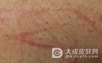 丘疹荨麻疹症状是如何发作的呢