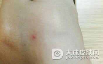 鲜红斑痣是什么原因引起的