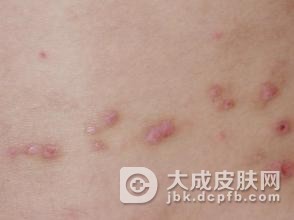 怎样预防结节性痒疹的病发