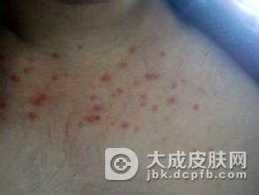 鲜红斑痣的治疗