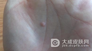 儿童得了寻常疣怎么办