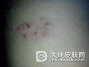 如何识别带状疱疹的症状类型