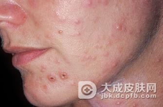 带状疱疹患者应该怎样护理有助病情康复