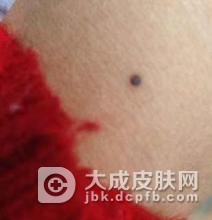 鲜红斑痣会有什么危害
