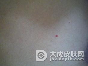 扁平苔藓的系统症状有哪些