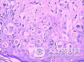八种扁平苔藓的预防措施