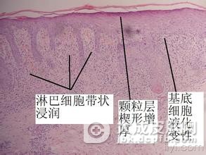 得了扁平苔藓不能吃什么
