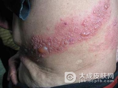 带状疱疹带来的困扰不言而喻