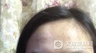 花斑癣应该怎样治疗