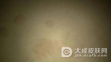 治疗花斑癣的方法有什么