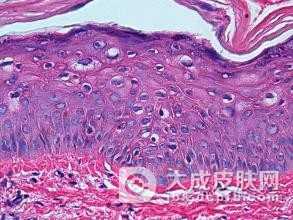易患花斑癣的人群怎么预防