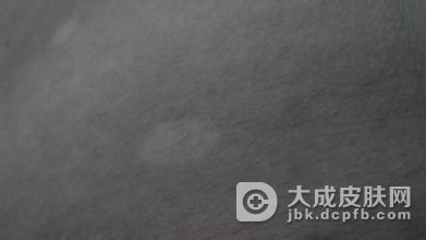 生活中预防花斑癣要怎么做