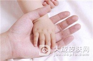 干性湿疹的预防方法