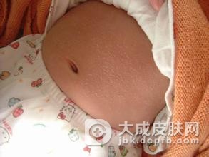 秋季预防干性湿疹的方法有哪些