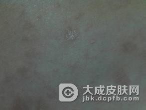 花斑癣的类型有哪些