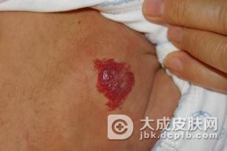 血管瘤的危害和治疗