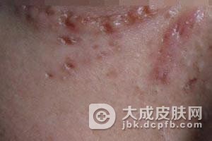 盘状寻常狼疮结节是怎么发病的