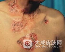 寻常狼疮并发症有什么