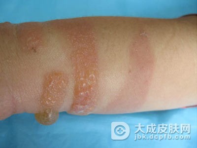 染发皮炎的护理方法都有什么呢