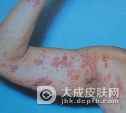 得系统性红斑狼疮会传染吗
