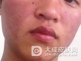 红斑狼疮患者不能吃什么食物