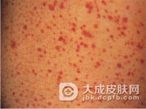 怎么样会导致异位性皮炎