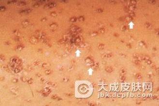 三期梅毒的症状变化