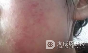 脂溢性皮炎患者必须注意什么