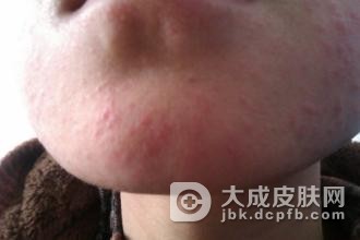 脂溢性皮炎要做哪些诊断工作