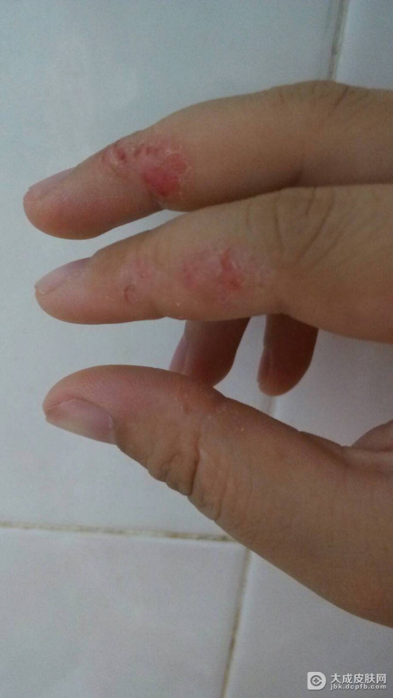 专家教你慢性荨麻疹的科学护理