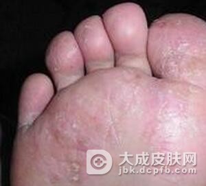 脚气患者如何护理呢