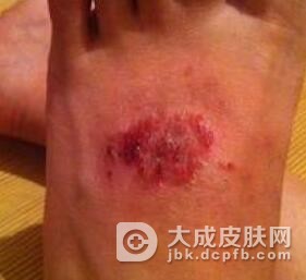 怎样才能够预防脚气发生
