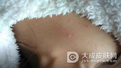 荨麻疹应该如何正确预防