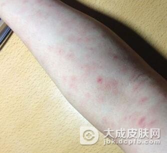 玫瑰糠疹会长脸上吗