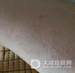 玫瑰糠疹怎么才能止痒