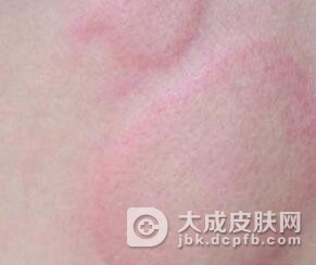 发生皮肤过敏可以怎样治疗