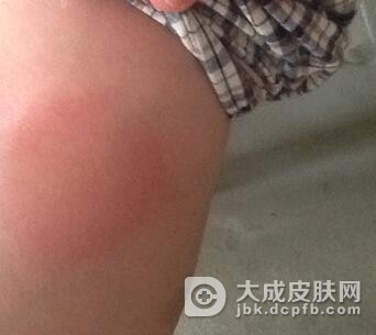 疱疹样皮炎需如何治疗