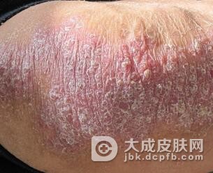 牛皮癣到底有什么危害呢
