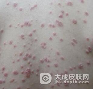 小儿银屑病的预防