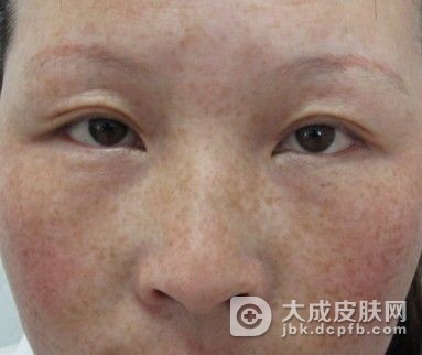有效去除雀斑的方法是什么呢