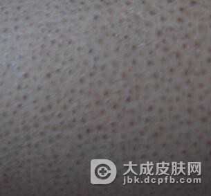 有鱼鳞病在饮食上需要注意什么?